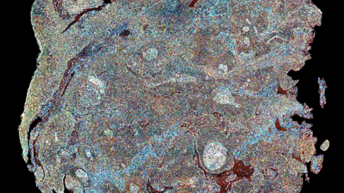 A broadband SRS image of human head and neck tumour tissue with scale indicated 