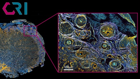 A Raman image of tissue from a human head and neck cancer, indicating the chemical makeup.